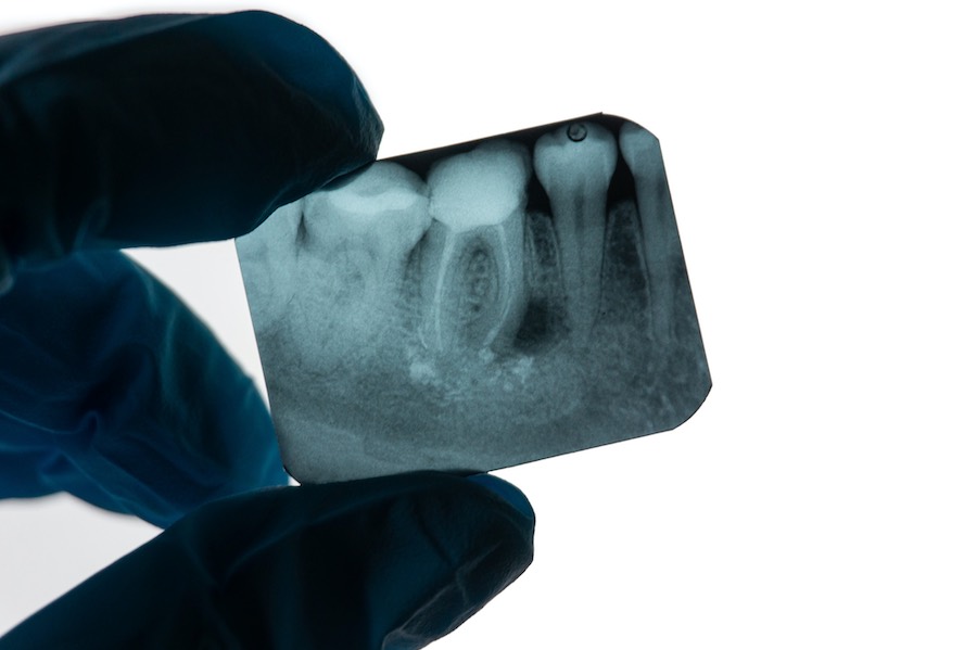 Retreat root fillings
