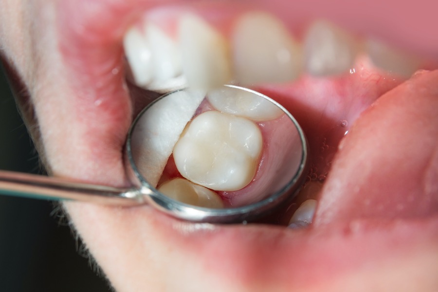 Tooth coloured fillings