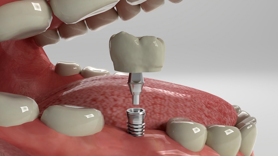 Teeth Implant Isle of Man