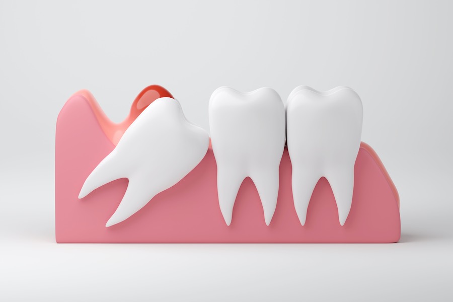 Wisdom tooth removal Isle of Man