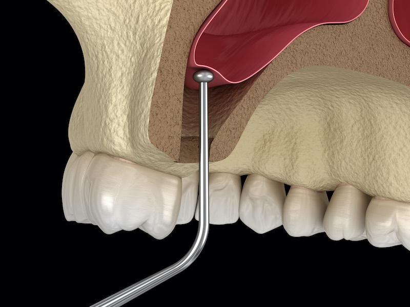 Sinus Lift Surgery