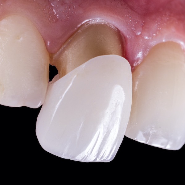 Veneers