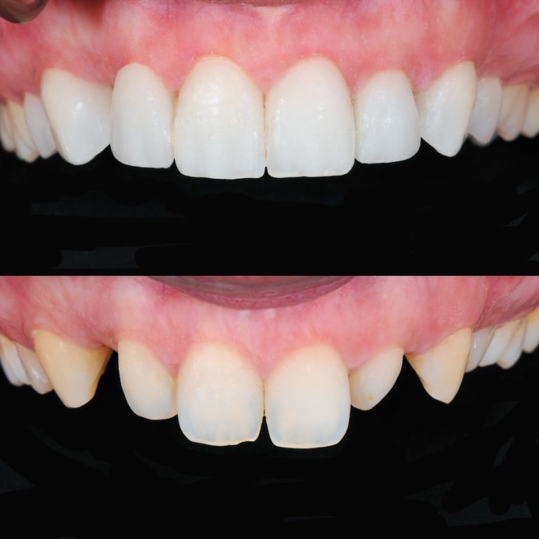 Composite bonding Isle of Man
