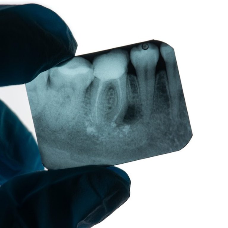 Retreat root fillings