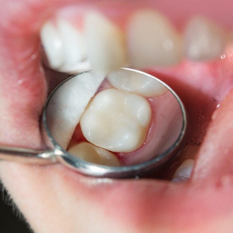 Tooth coloured fillings