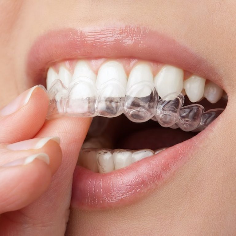 Essix Retainer